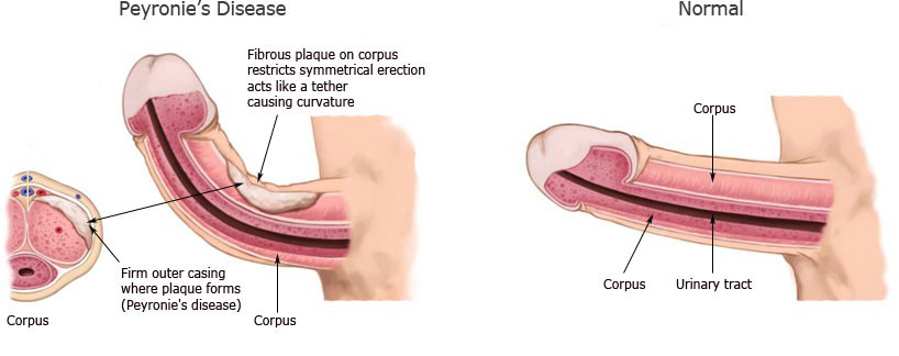 peyronies disease diagram image