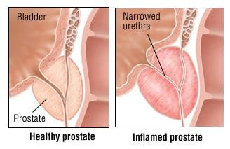 healthy-prostate-and-inflamed-prostate